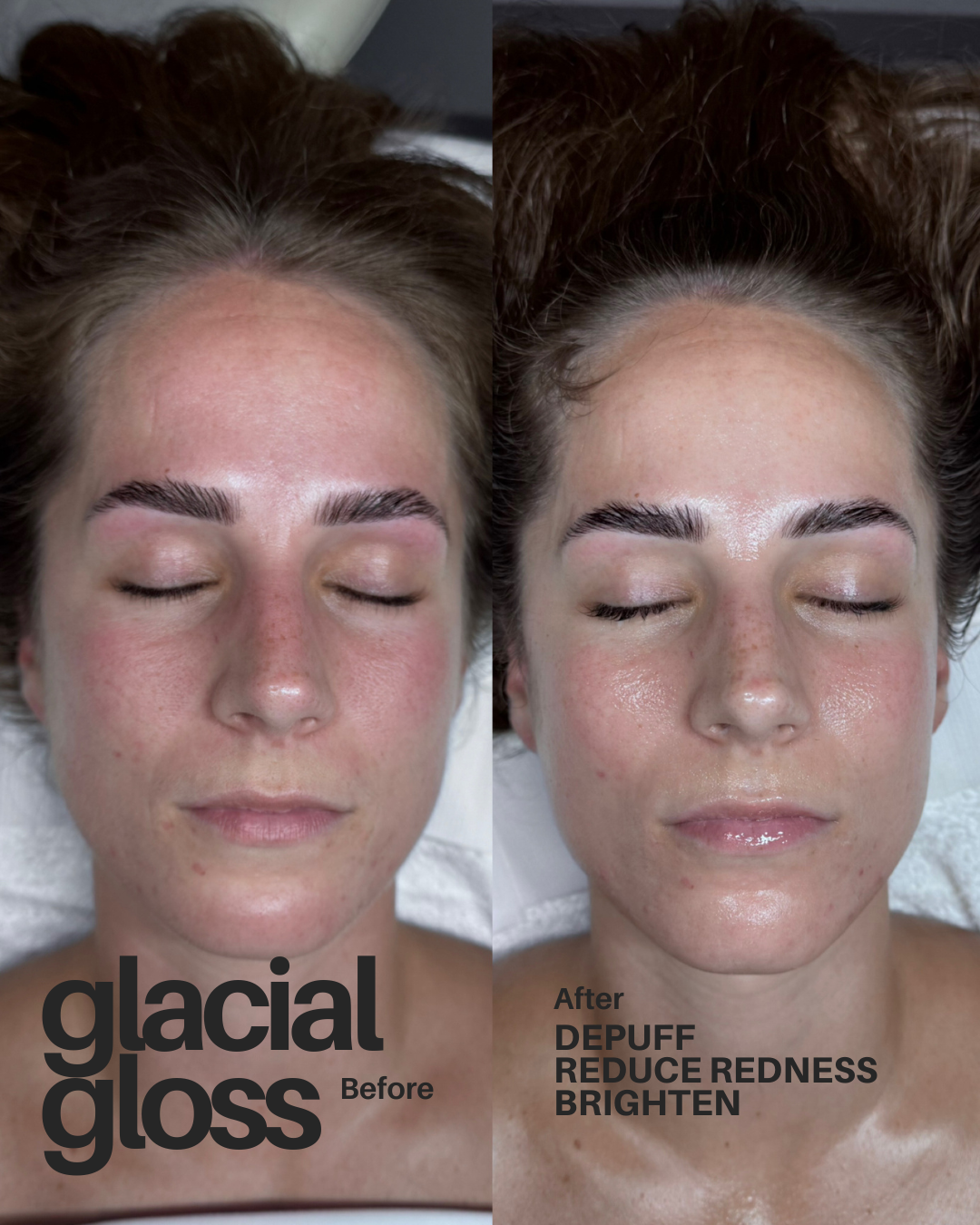 glacial_gloss_reduce_redness_wayzata.png