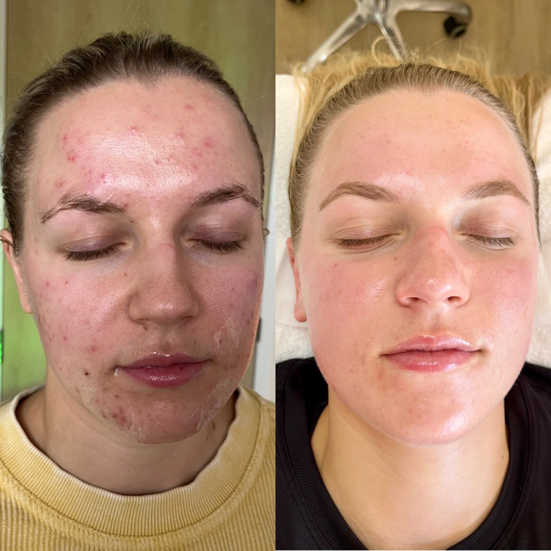 Adult client before and after results from professional acne facial program using Face Reality products in Minnesota.
