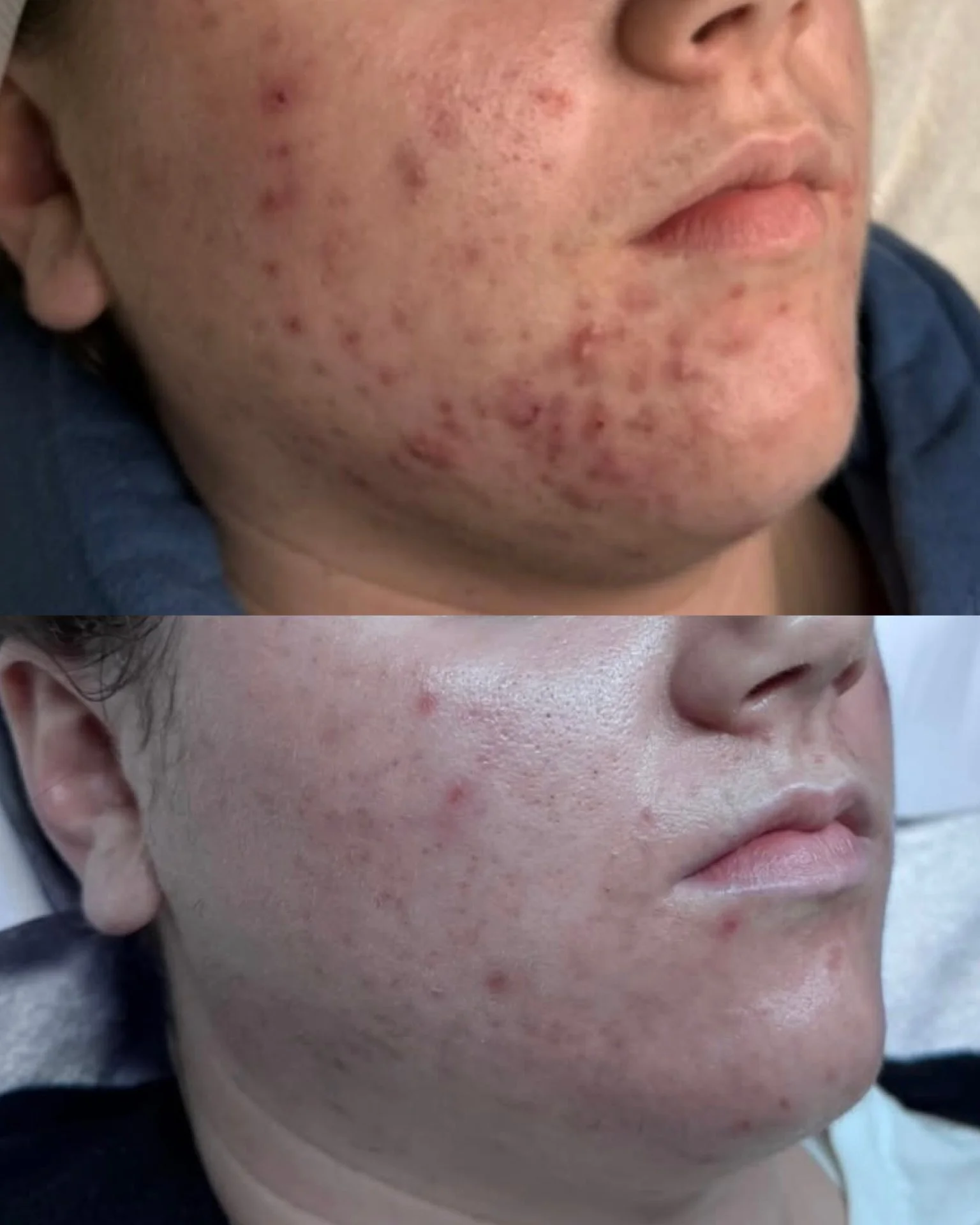 Minnesota client’s acne transformation after completing customized acne facials and Face Reality homecare program at The Skyn Distillery.