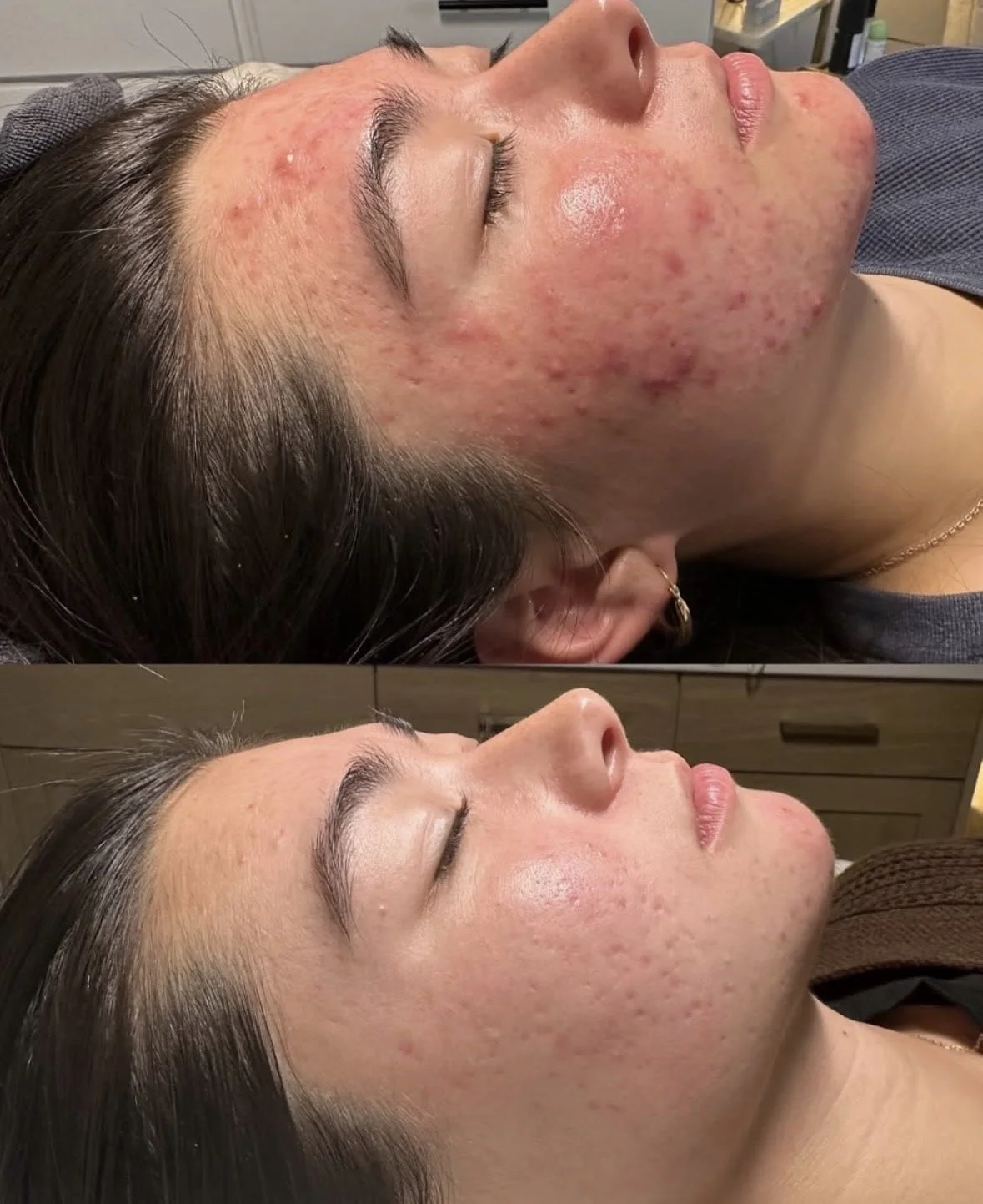 Acne facial before and after photos from Minnesota client treated with clinical homecare and in-studio treatments.
