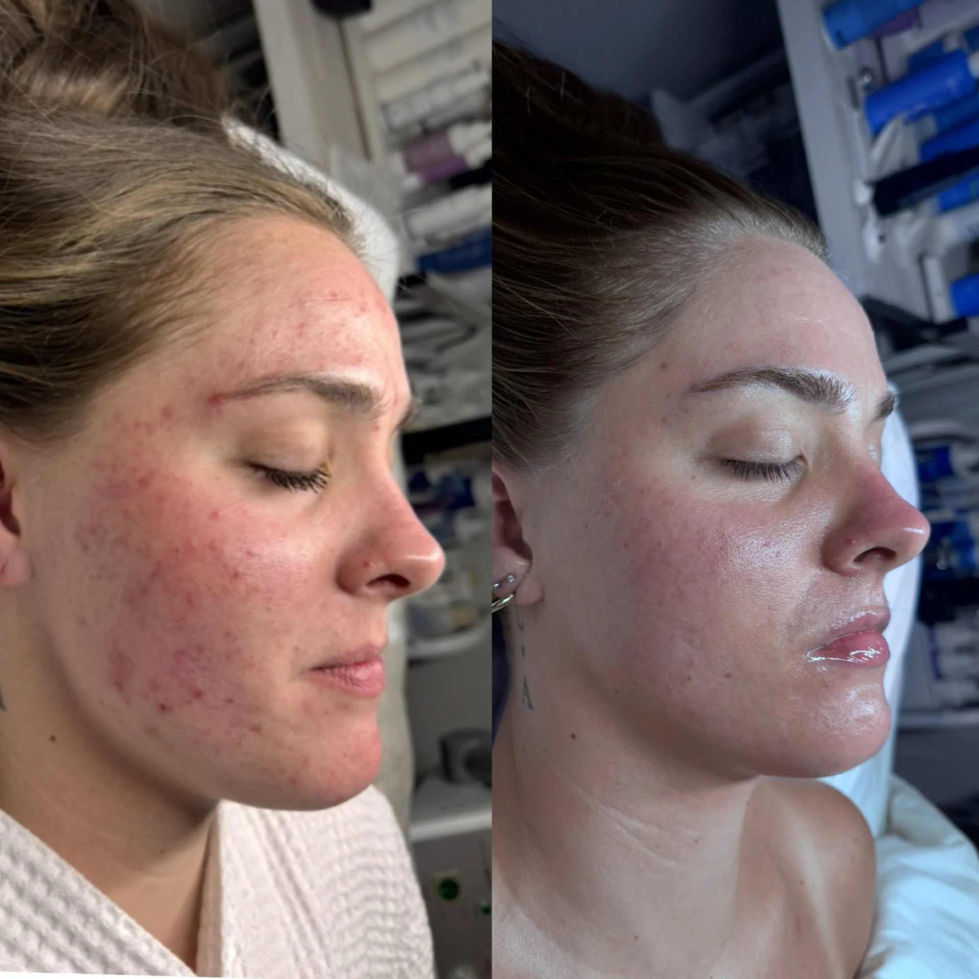 Before and after results from Face Reality Clear Skin Method at The Skyn Distillery in Wayzata, MN showing significant acne improvement.