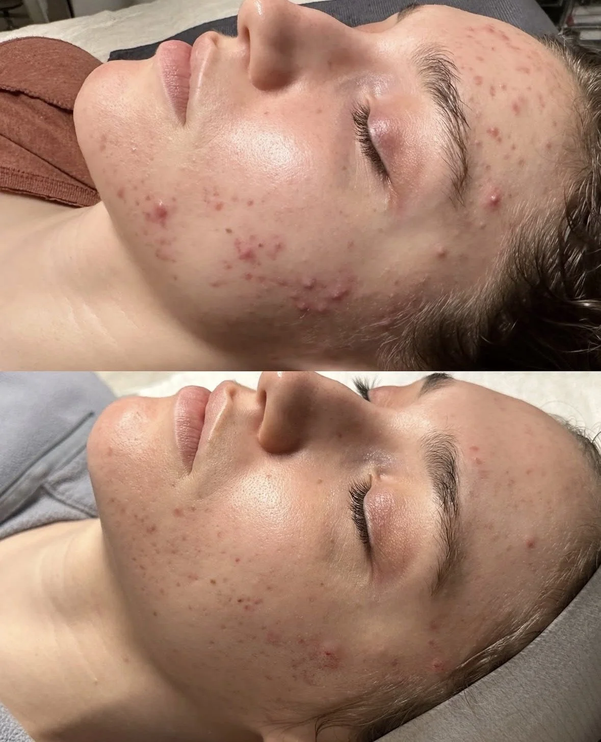 Before and after acne results from Face Reality Clear Skin Method in Wayzata, MN demonstrating long-term breakout control and clearer skin.