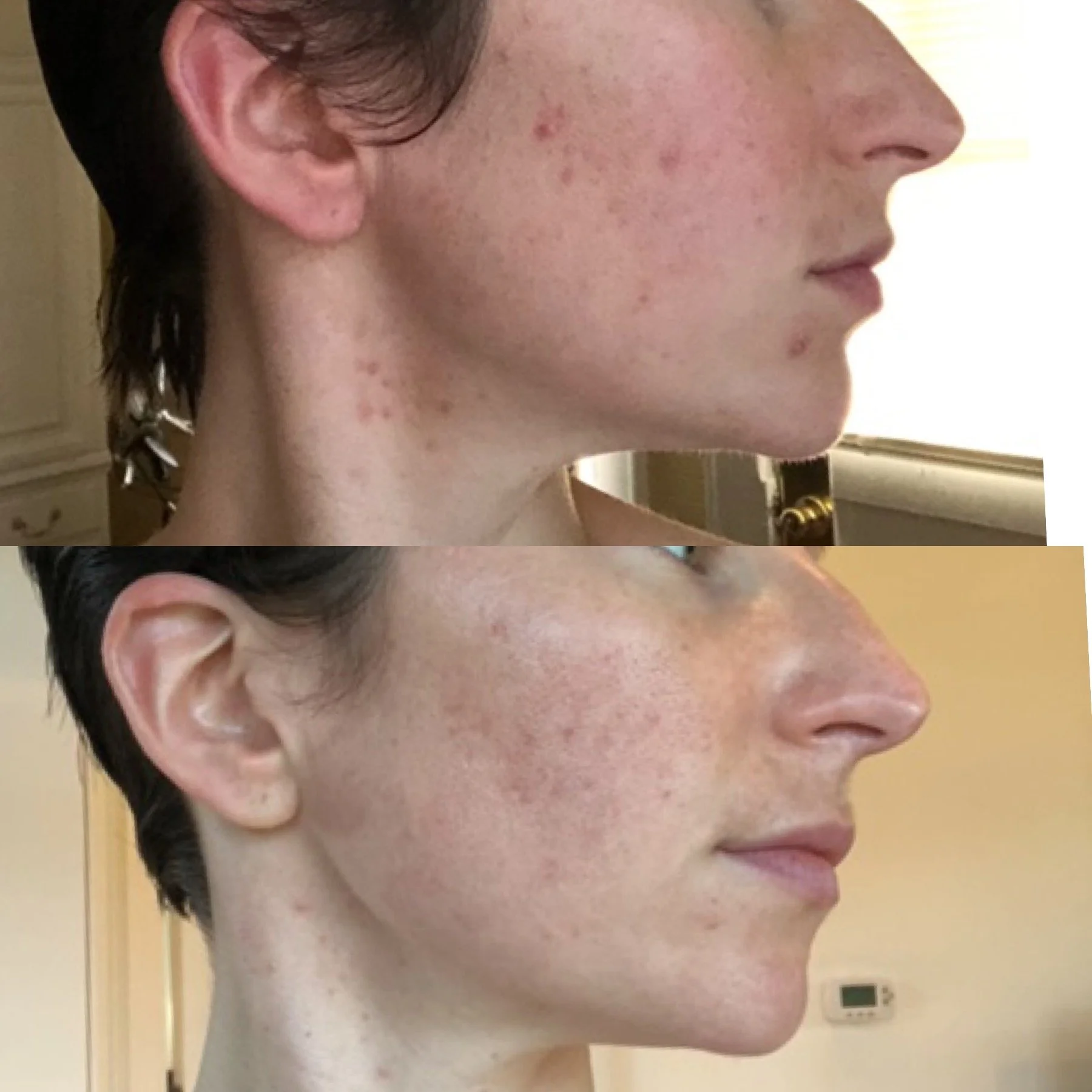 Virtual Face Reality Acne Bootcamp in Wayzata, MN Skincare Studio.