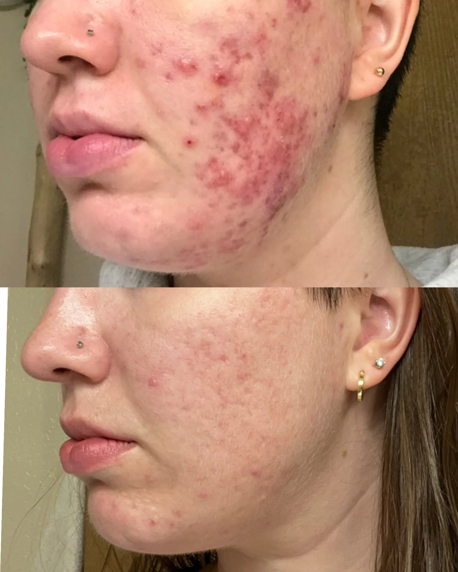 Clear your skin with our face reality acne bootcamp located in the Twin Cities