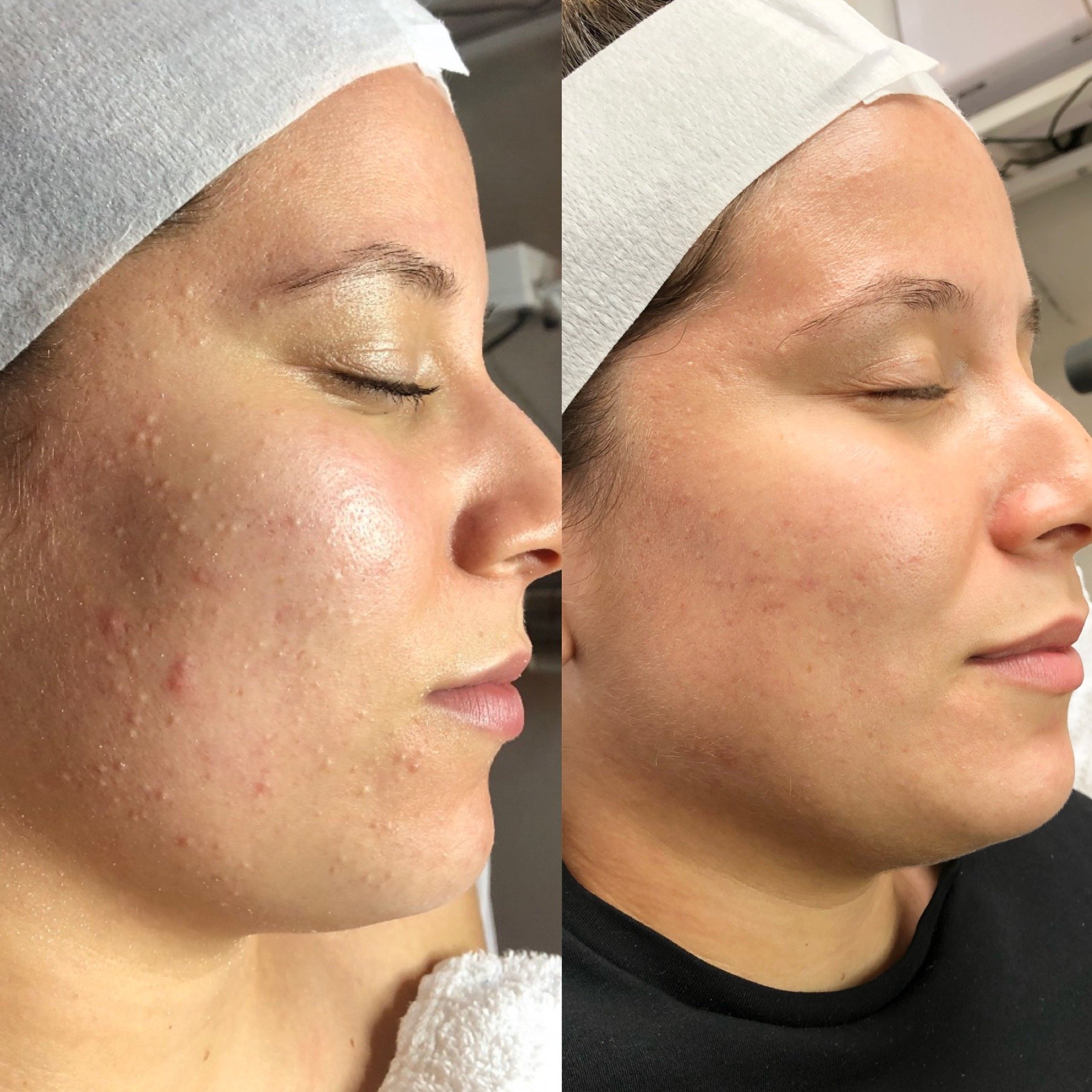 Client success story showing clearer skin after participating in Face Reality Clear Skin Method in the Twin Cities.