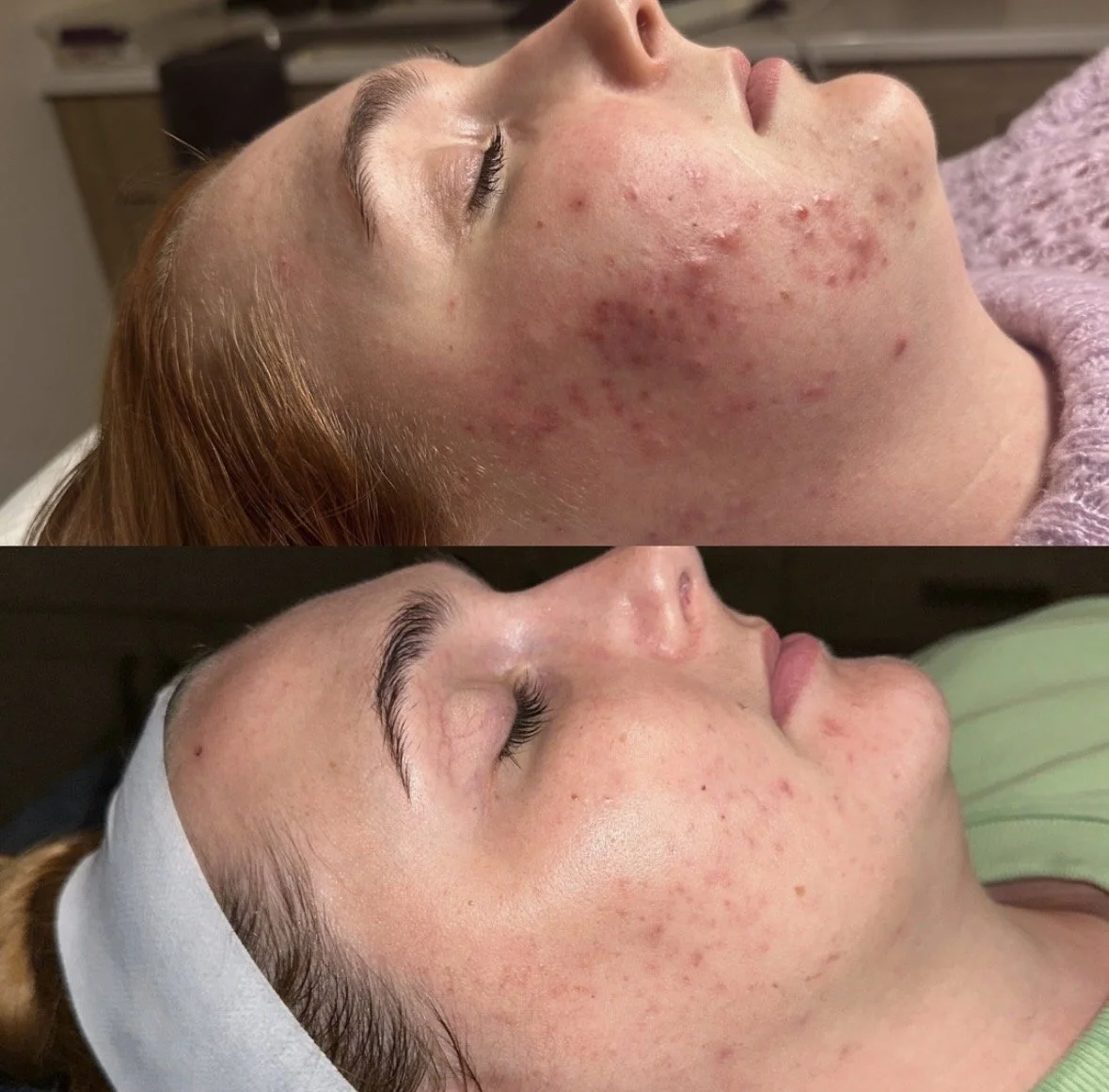 Face Reality acne treatment results showing calmer, clearer skin after structured Clear Skin Program.
