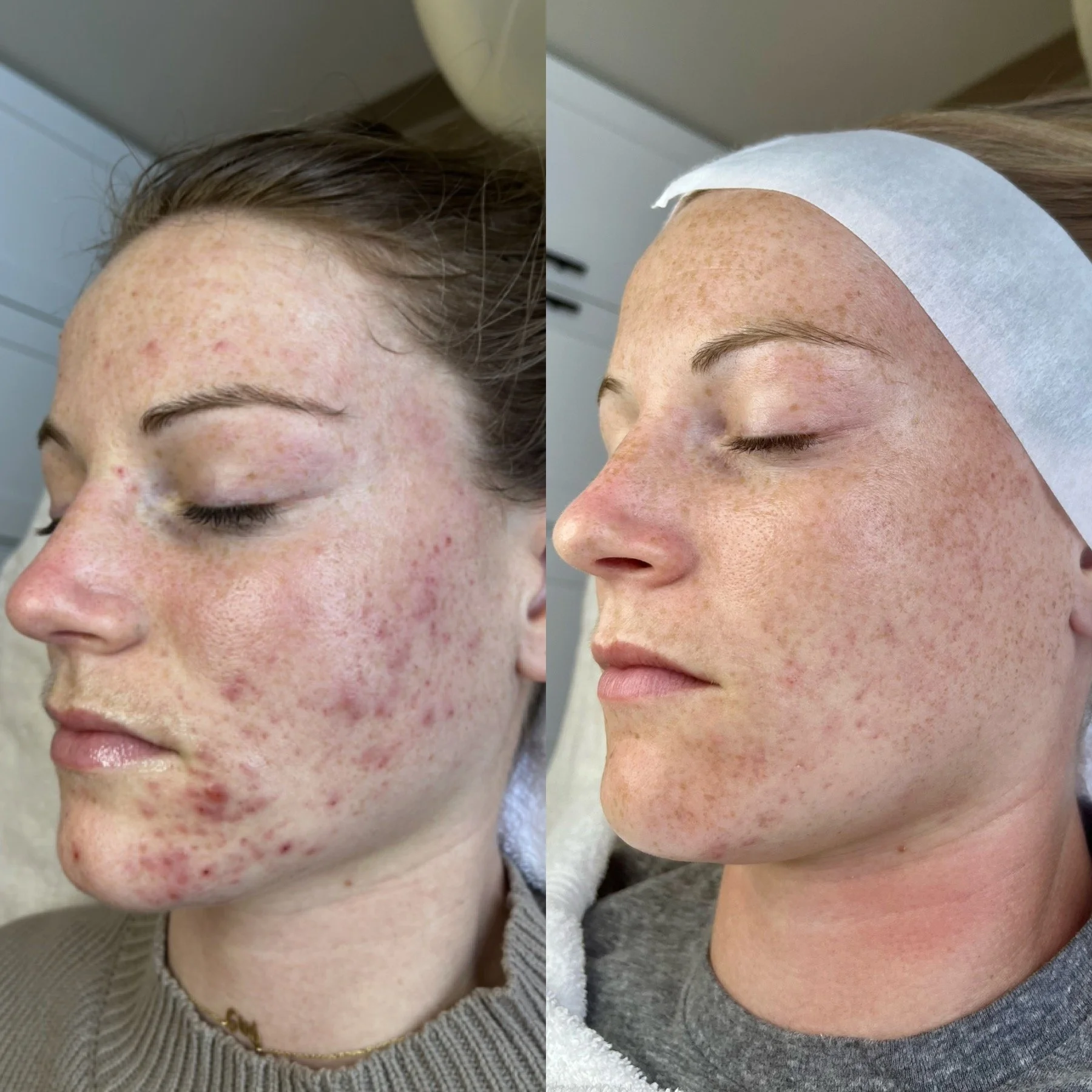 Acne transformation after completing customized Face Reality acne treatment program in Minnesota skincare studio.