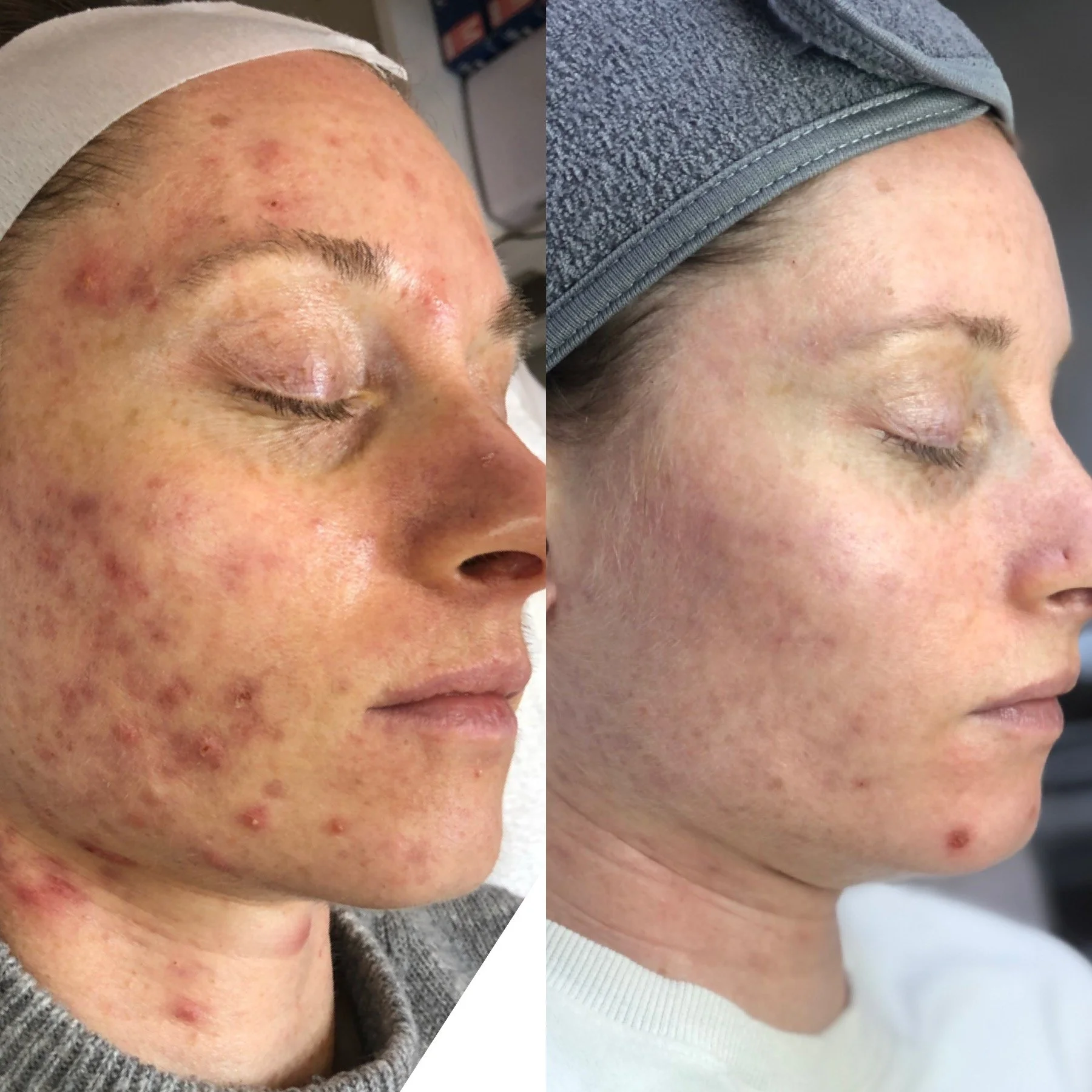 Visible reduction in breakouts and inflammation after consistent acne facials at Wayzata acne specialist studio.
