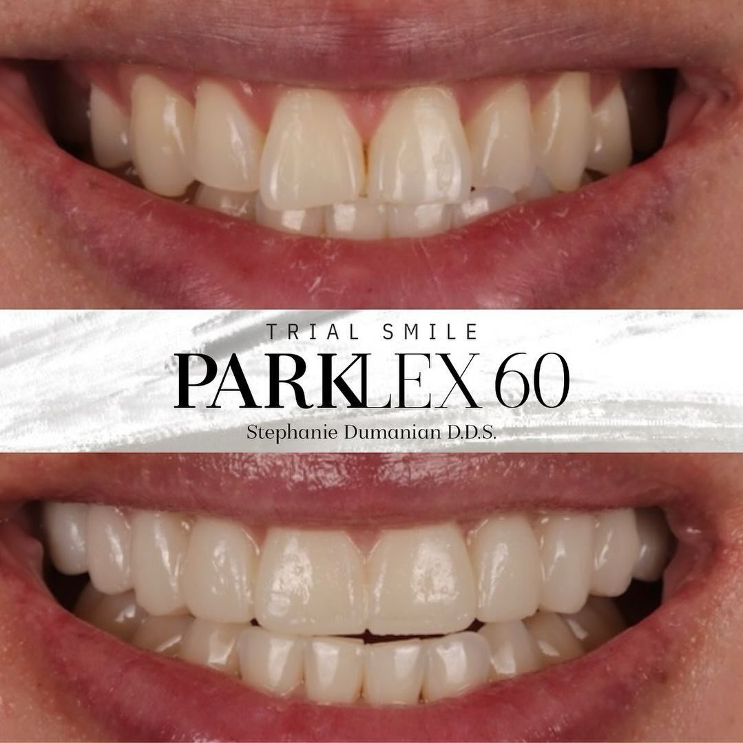They say perfection lies in the details, and when it comes to your smile, that couldn&rsquo;t be more true! Veneers are the ultimate secret to achieving a flawless smile, even for the tiniest imperfections. 
Say goodbye to those minor chips, stains, 