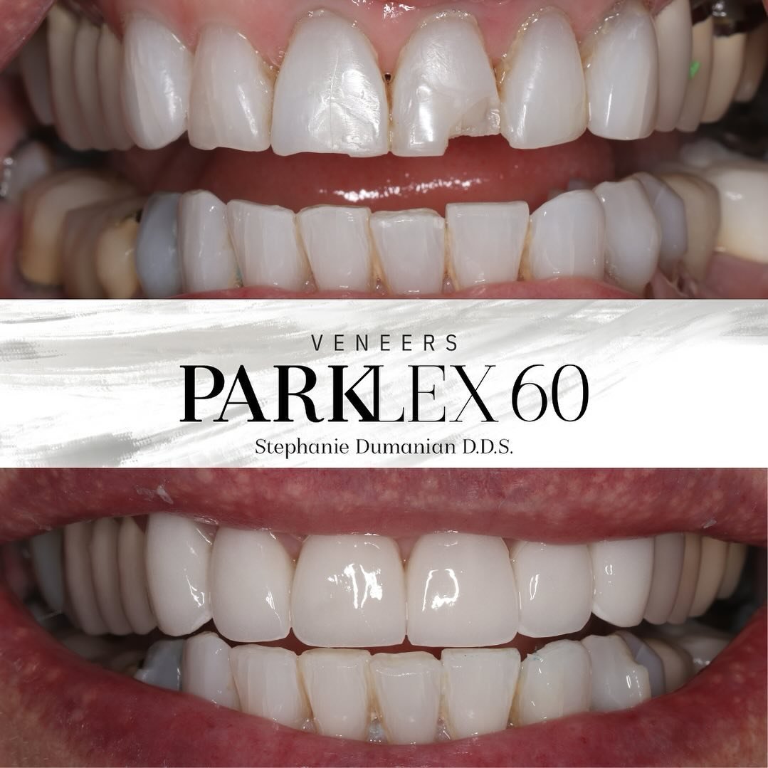🦷 Check out this stunning veneer transformation by Park Lex 60 Dental! Our patient came to us with chipped and discolored teeth, but after just a few visits, their smile is now brighter and more beautiful than ever before. Veneers are a great soluti