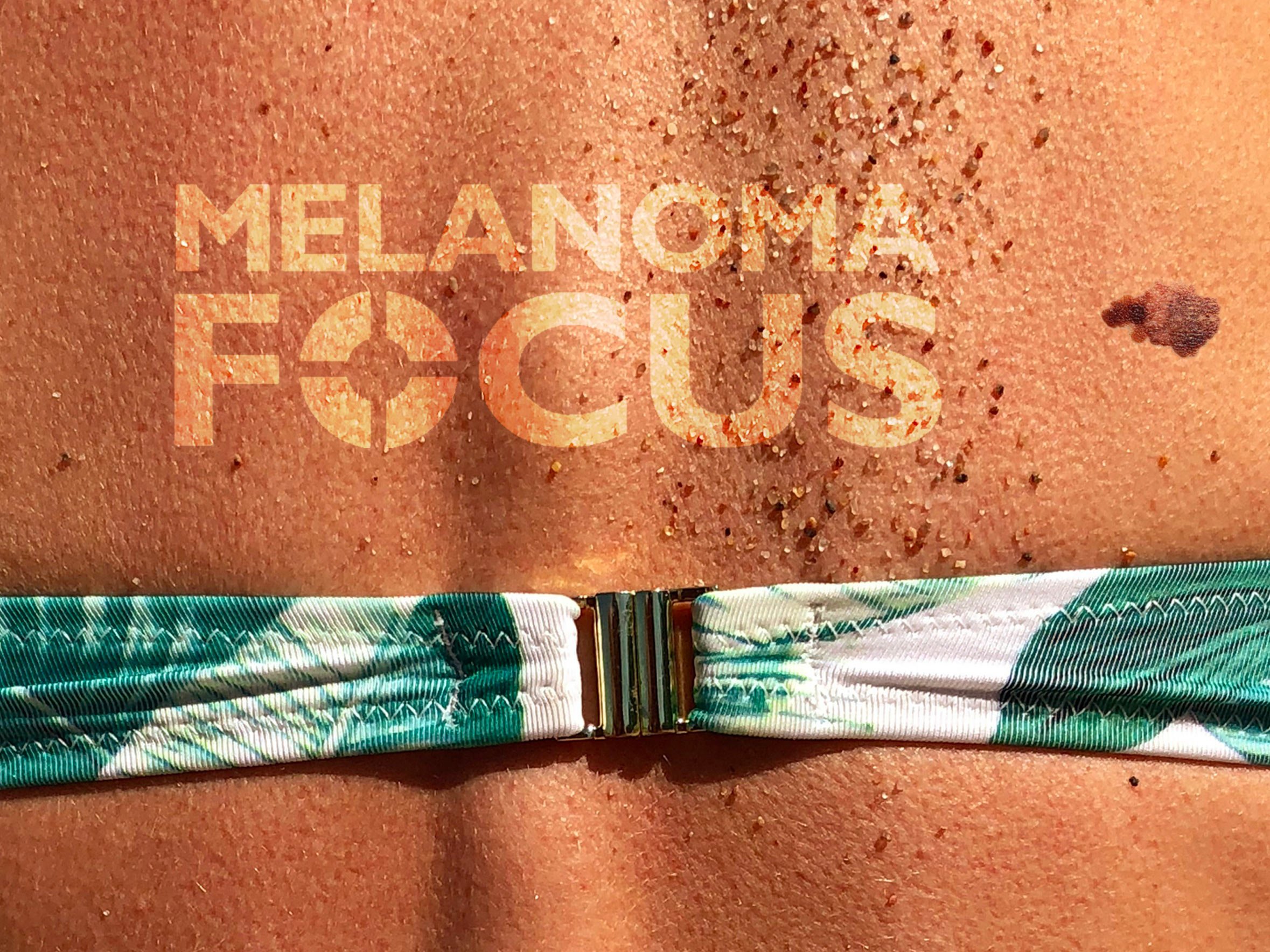 Melanoma Focus / Awareness Campaign & Graphic Design
