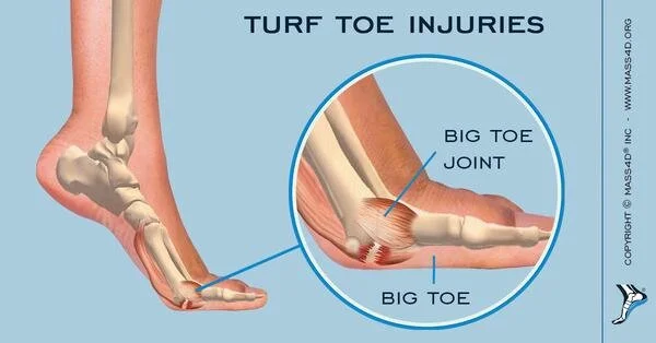 https://mass4d.com/blogs/articles/causes-and-symptoms-of-turf-toe-injuries
