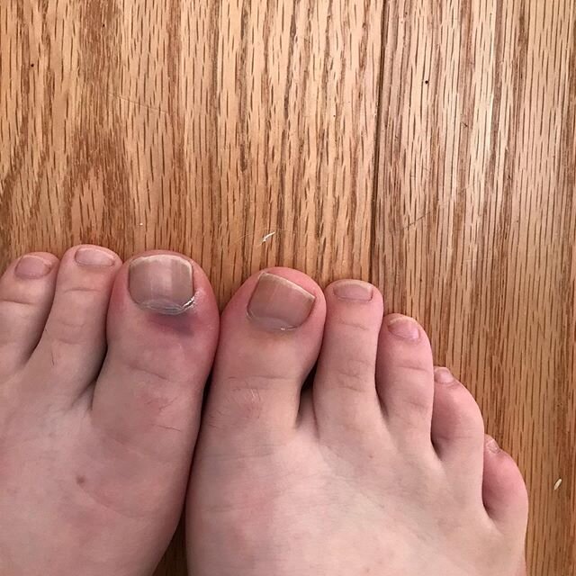 Sometimes you have to be your own PT. My one year old dropped a dumbbell smack on my left big toe. Picture one is about an hour afterwards. I applied kinesio tape as seen in picture two. Tape promotes circulation to an inflamed area. It lifts the ski