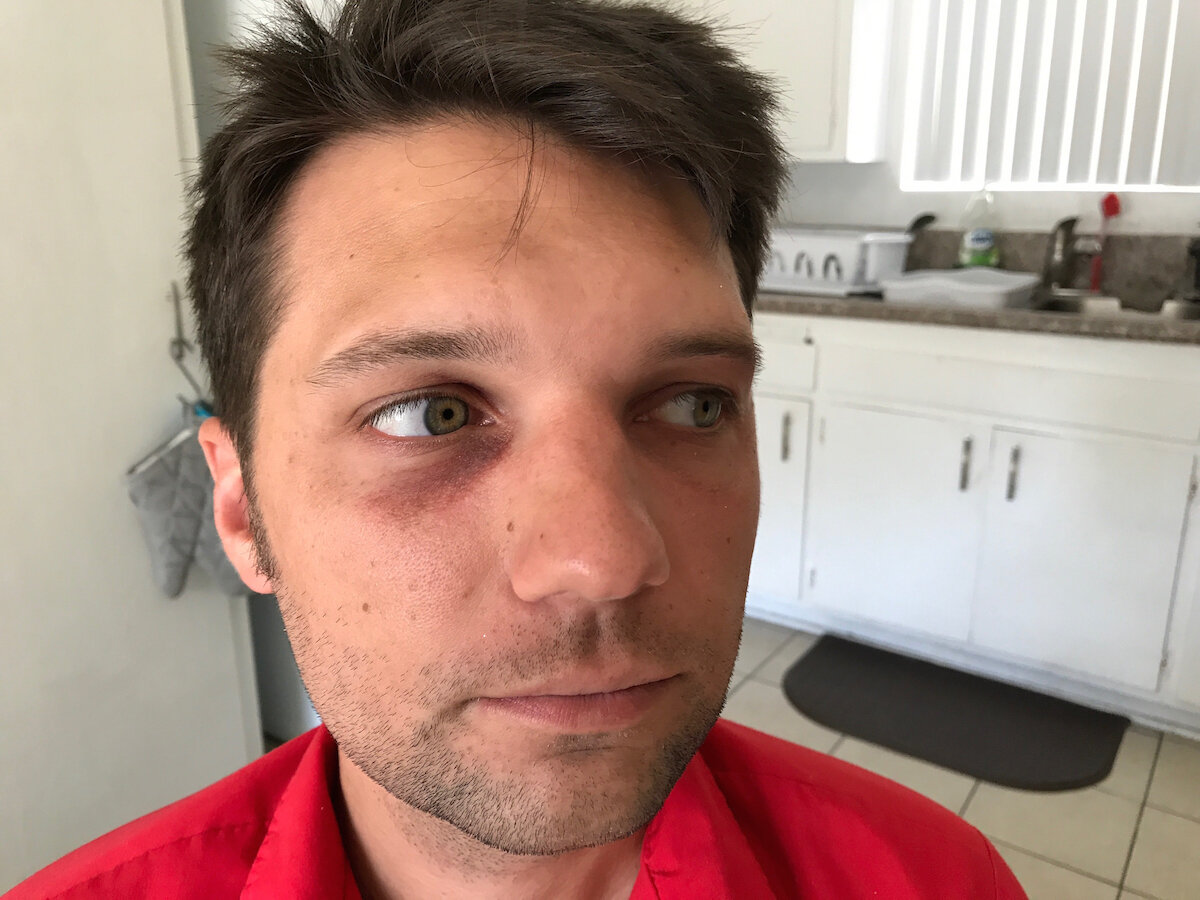 Black Eye