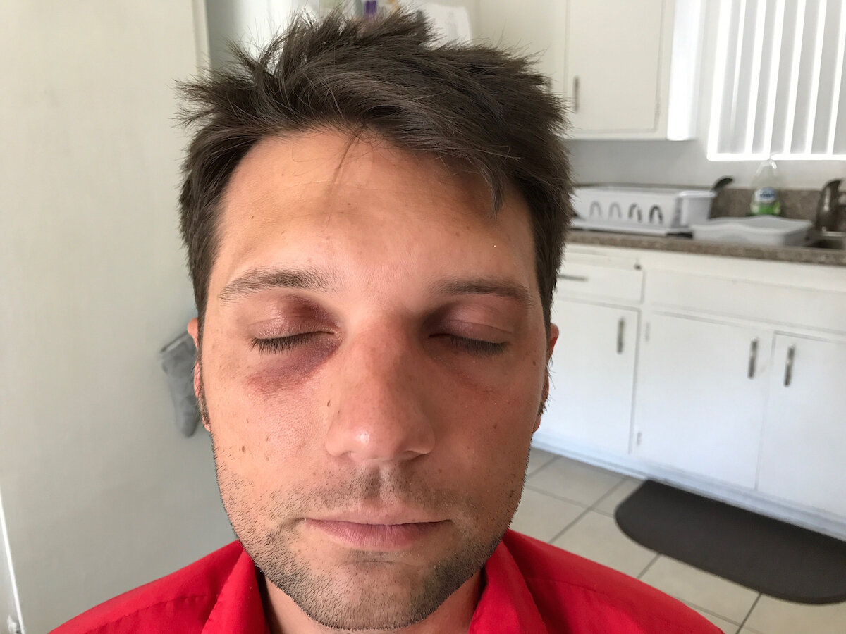 Black Eye