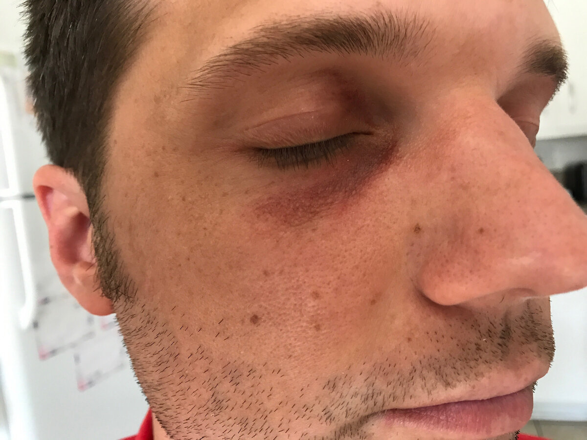 Black Eye