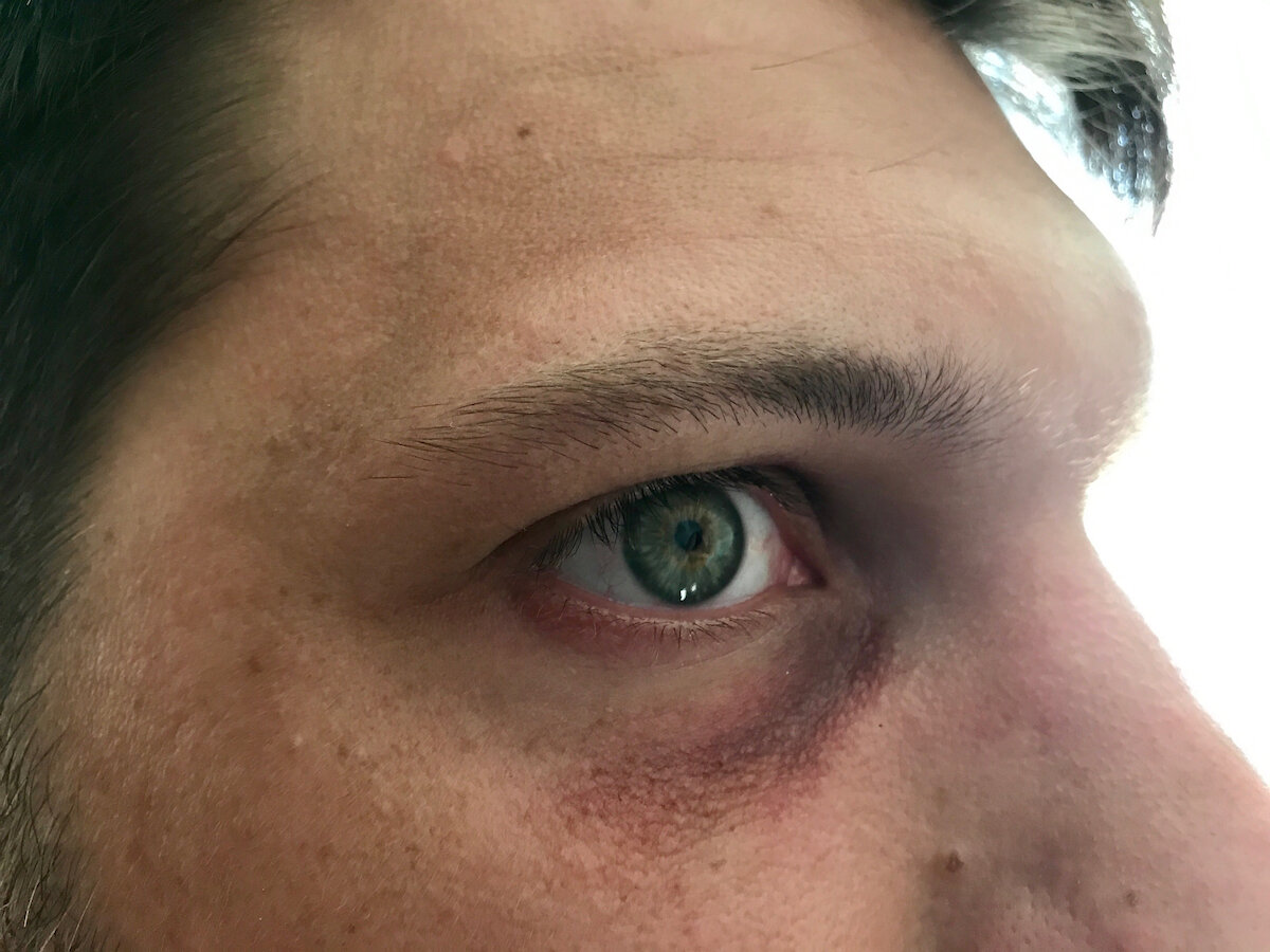 Black Eye