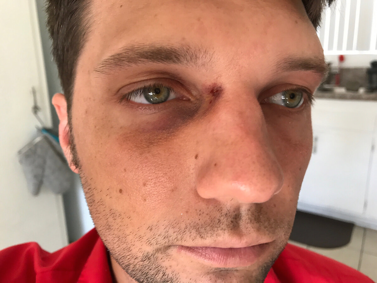 Black Eye with Blood Spot