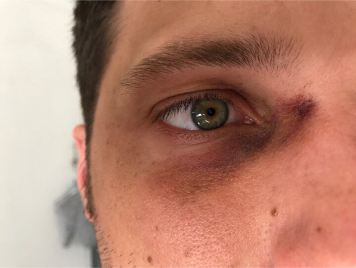 Black Eye with Blood Spot