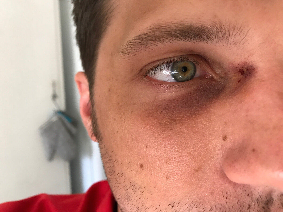 Black Eye with Blood Spot