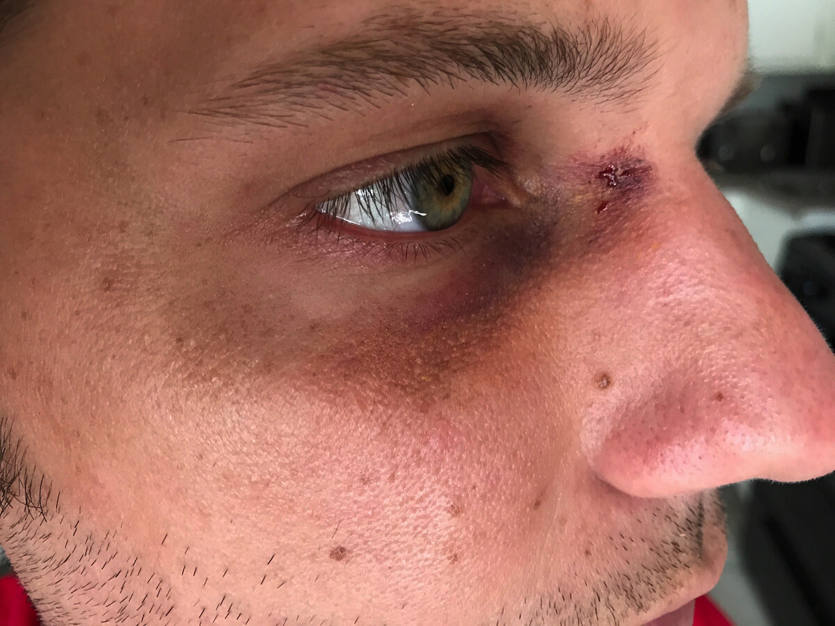 Black Eye with Blood Spot