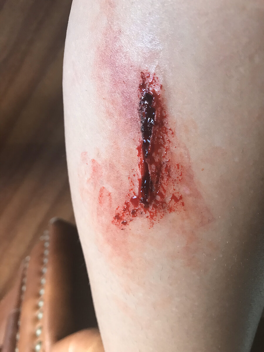 Wound