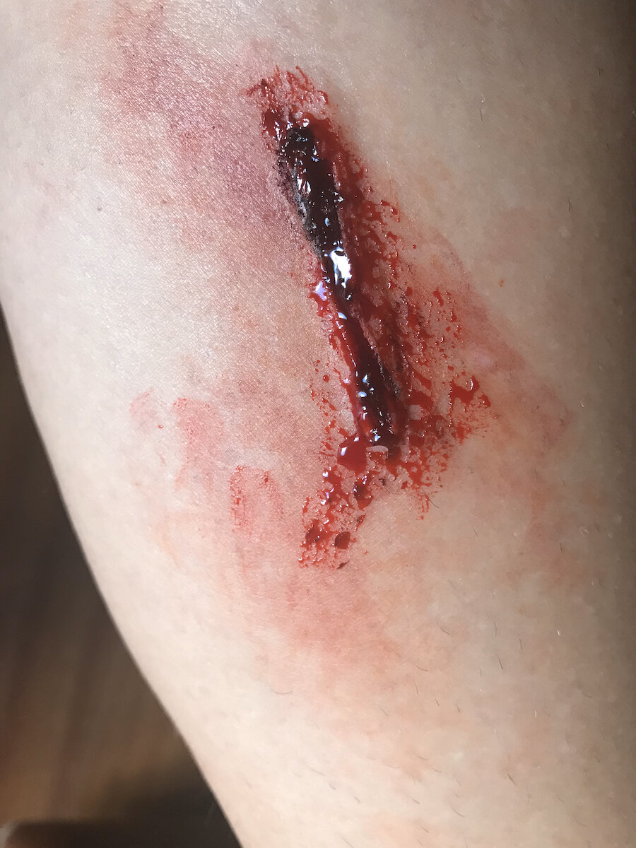 Wound