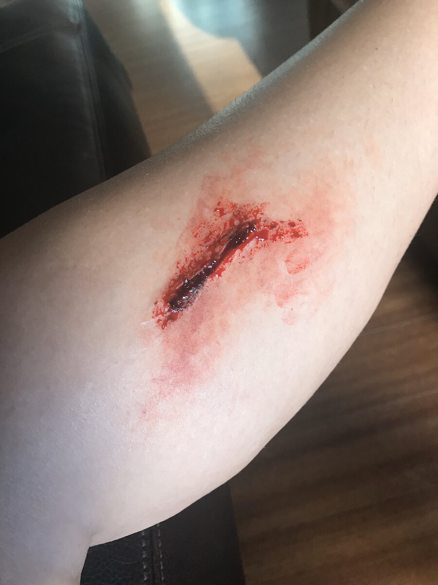 Wound