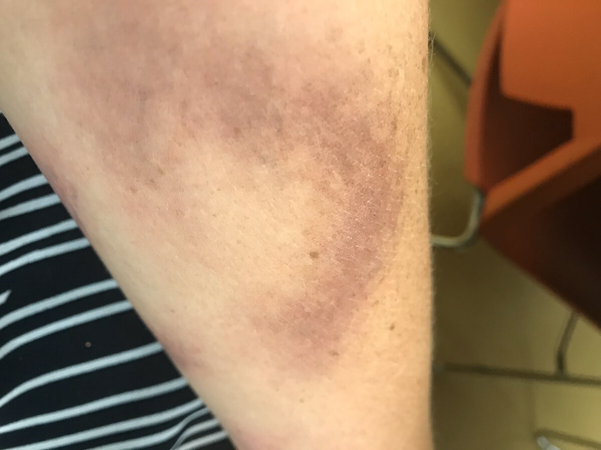 Bruise