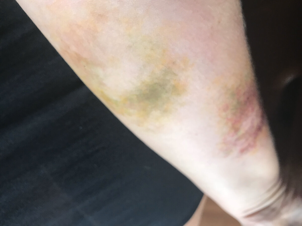 Aging Bruise