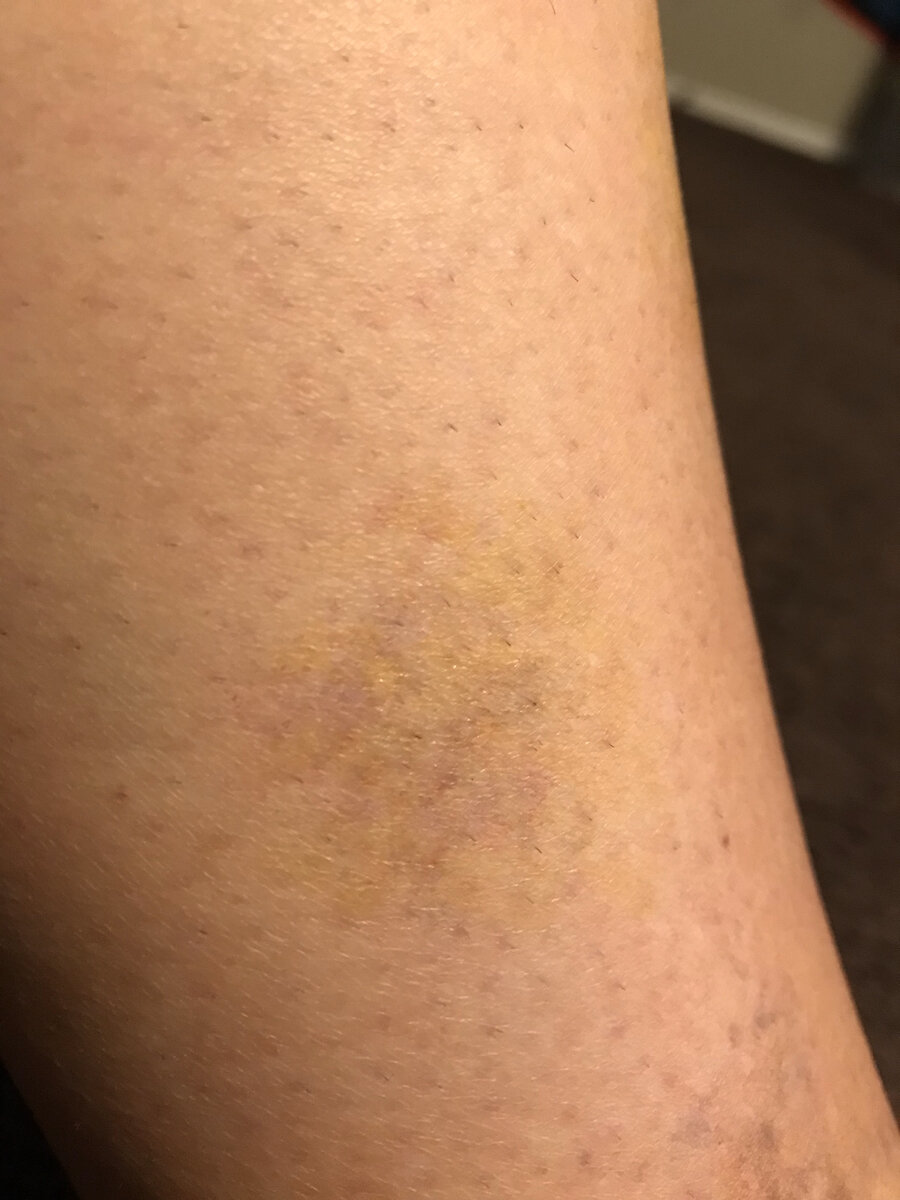 Aging Bruise (Fading)