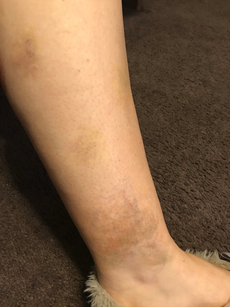 Aging Bruise (Fading)