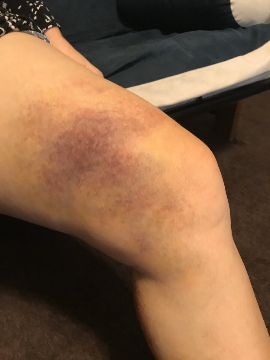 Large Bruise On Leg