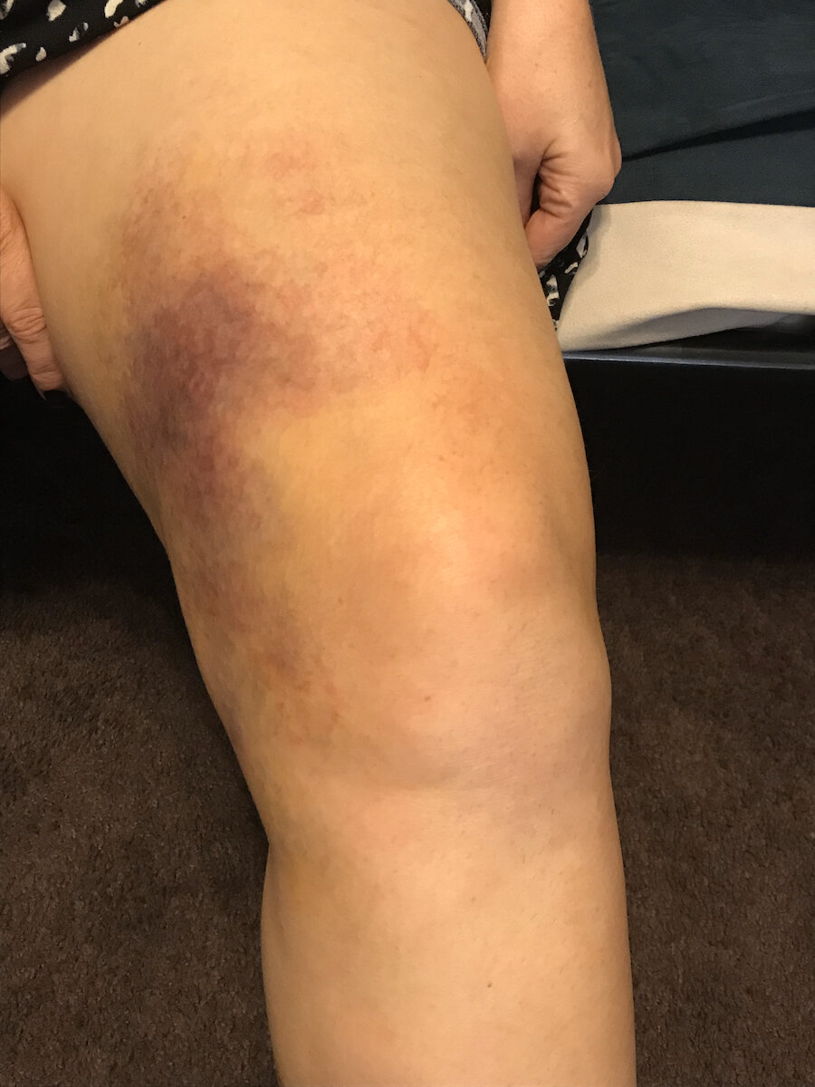 Large Bruise On Leg