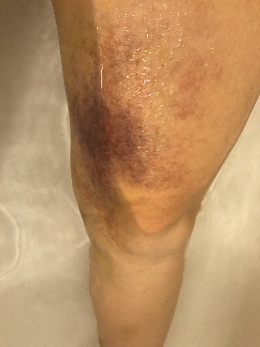 Large Bruise On Leg (In Water)
