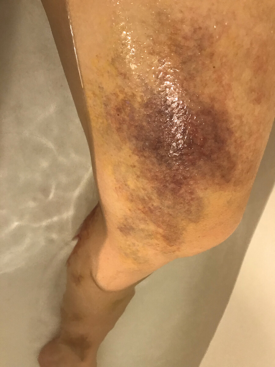 Large Bruise On Leg (In Water)