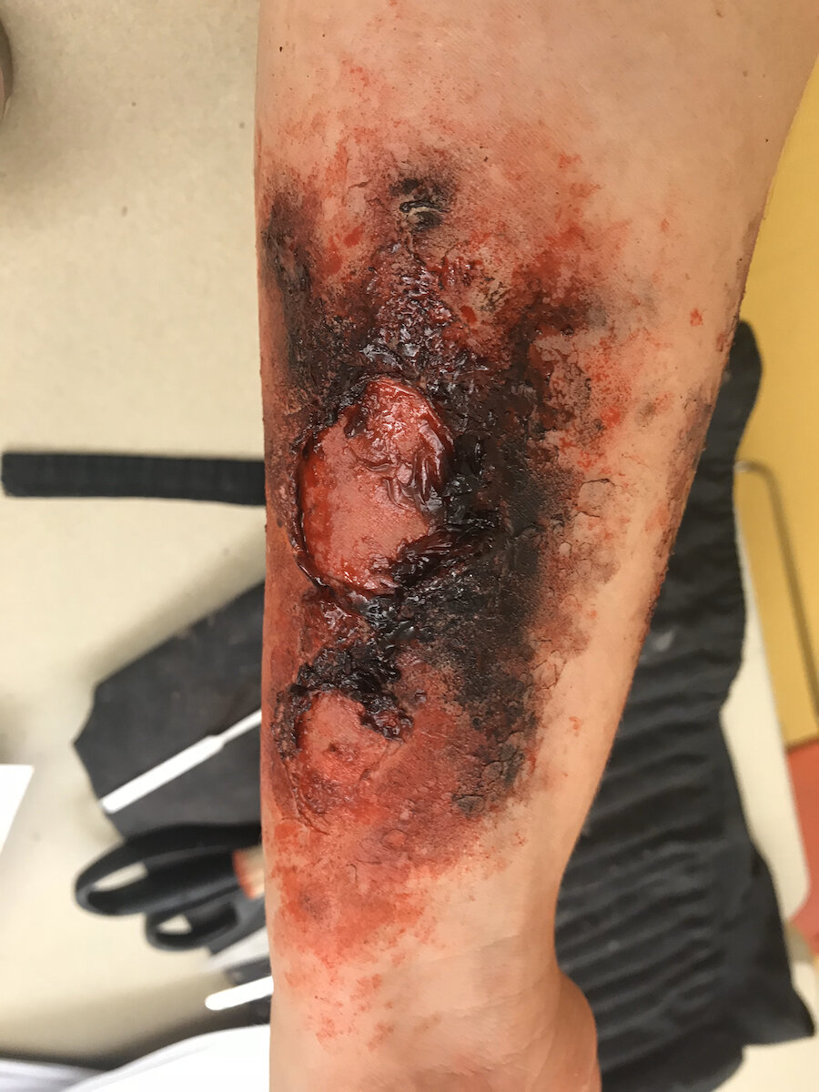 Burn (3rd Degree)
