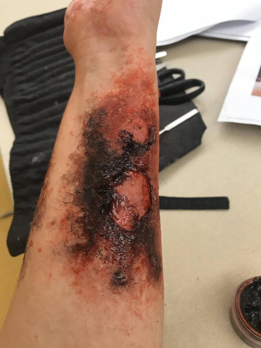 Burn (3rd Degree)