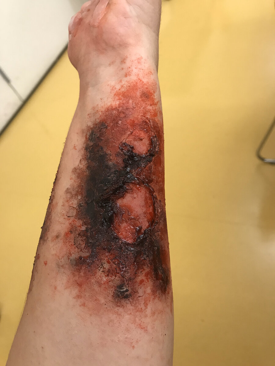 Burn (3rd Degree)