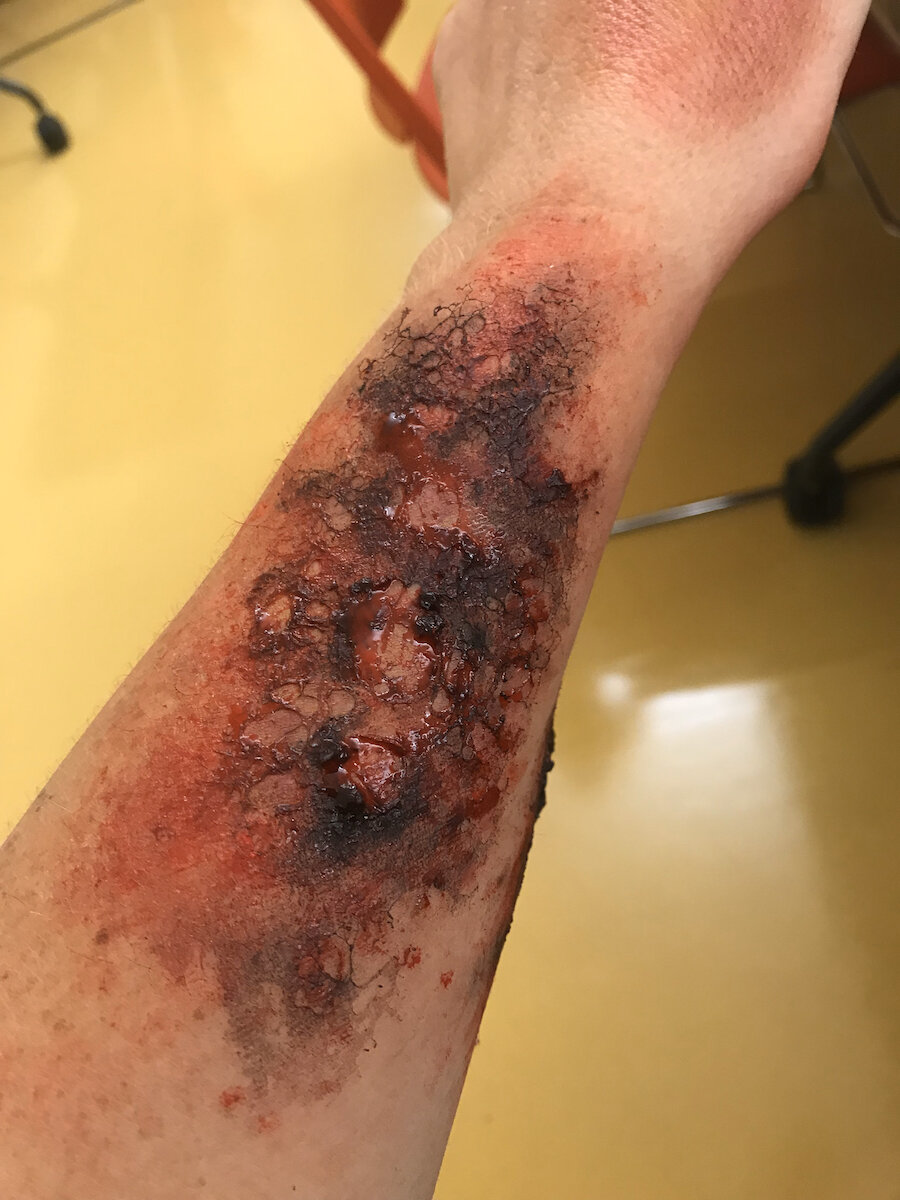 Burn (2nd Degree)