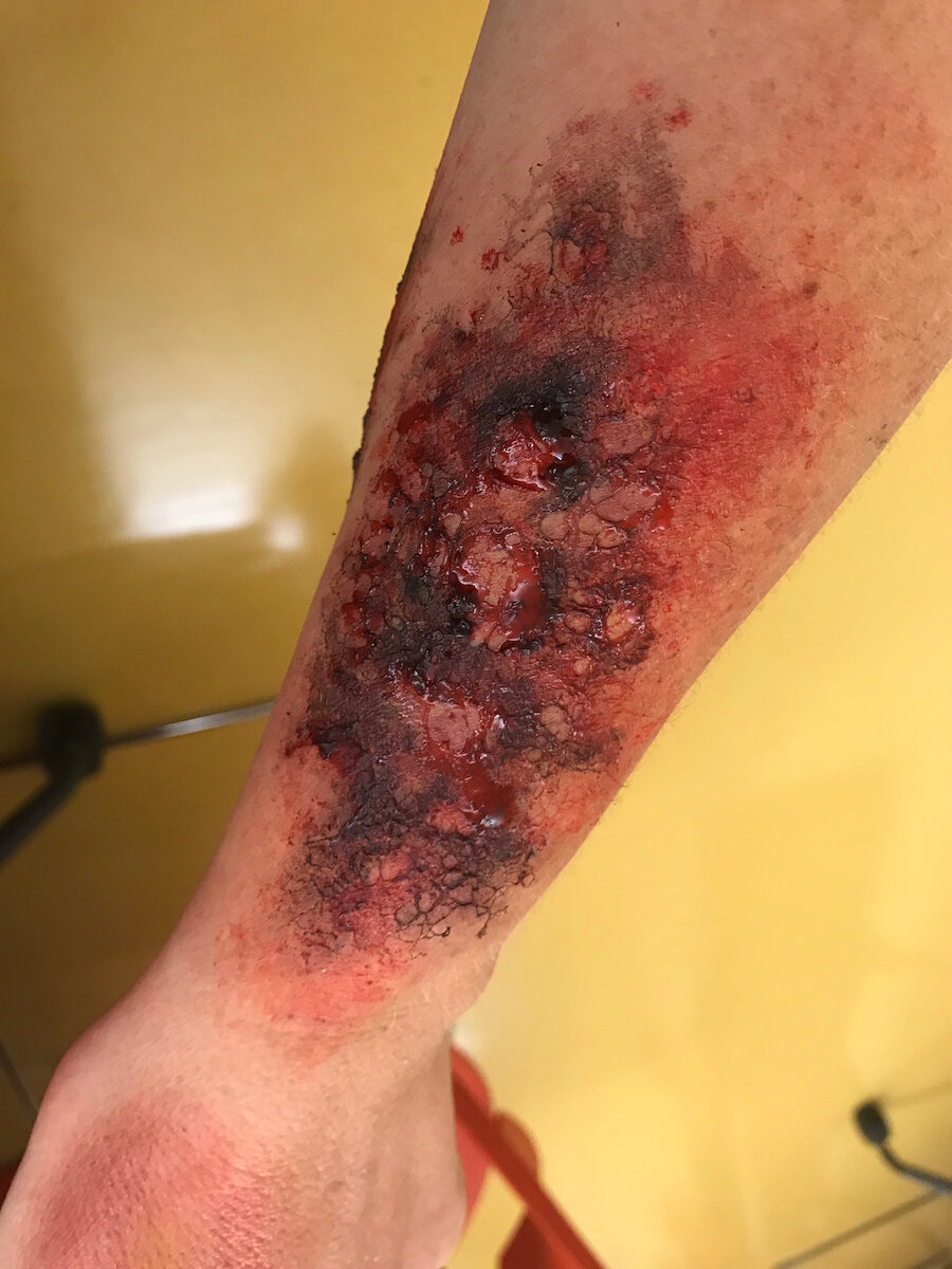 Burn (2nd Degree)