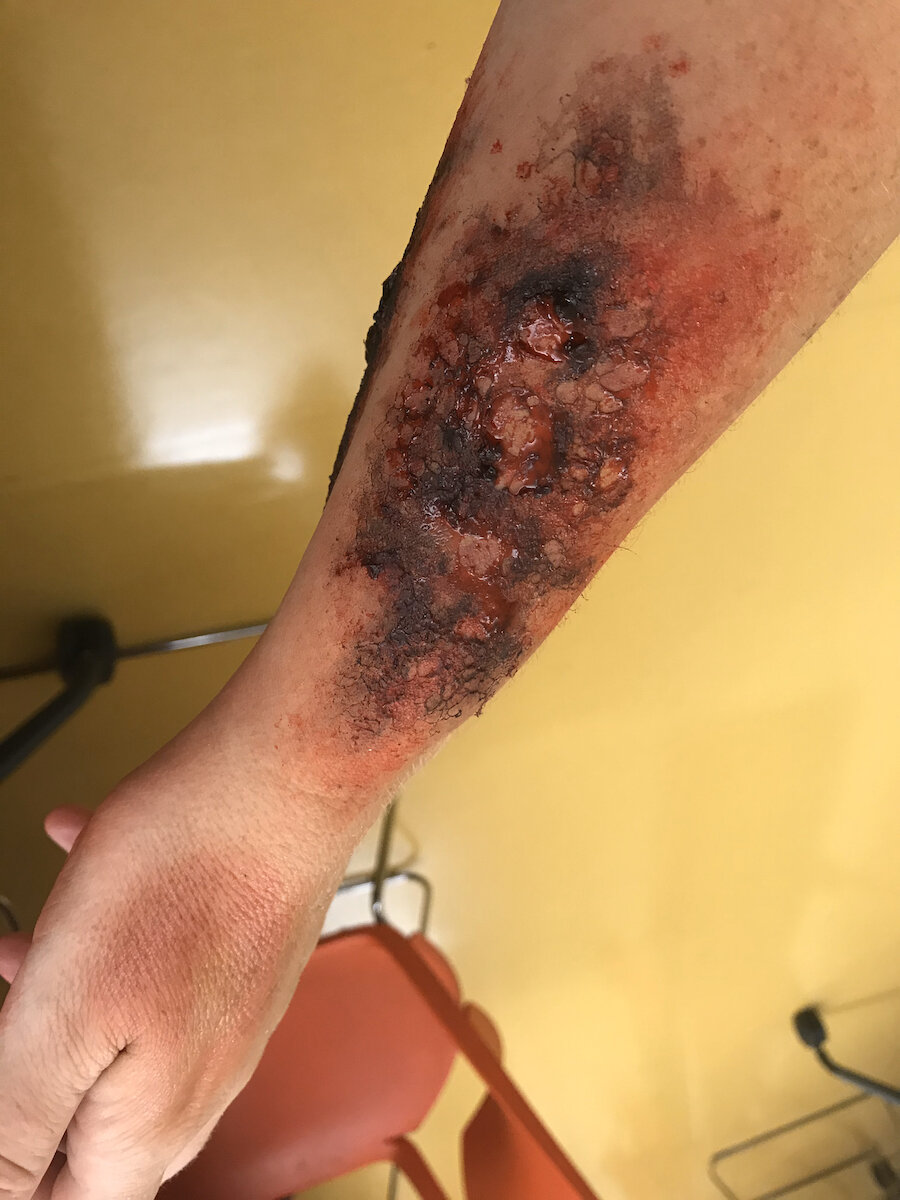 Burn (2nd Degree)