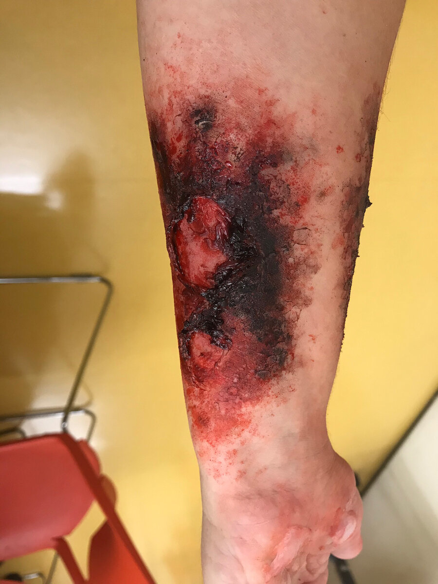 Burn (3rd Degree)