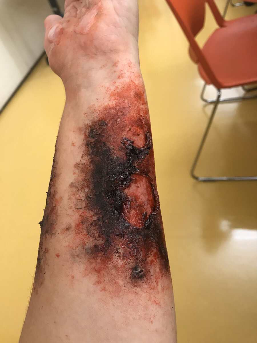 Burn (3rd Degree)