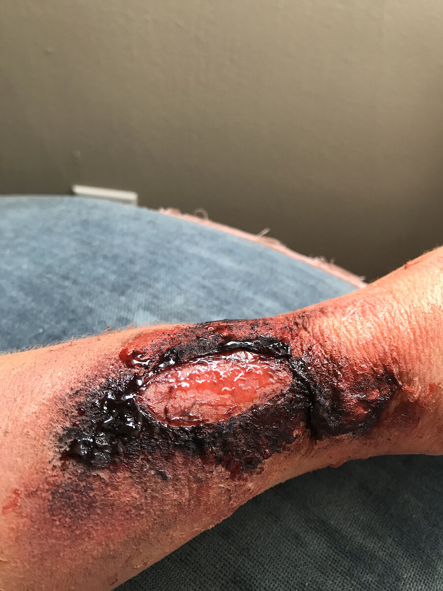 Burn (3rd Degree - Open Flesh)