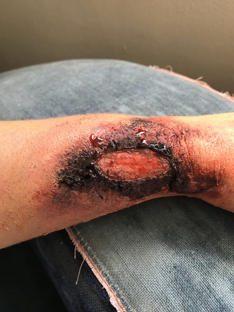 Burn (3rd Degree - Open Flesh)