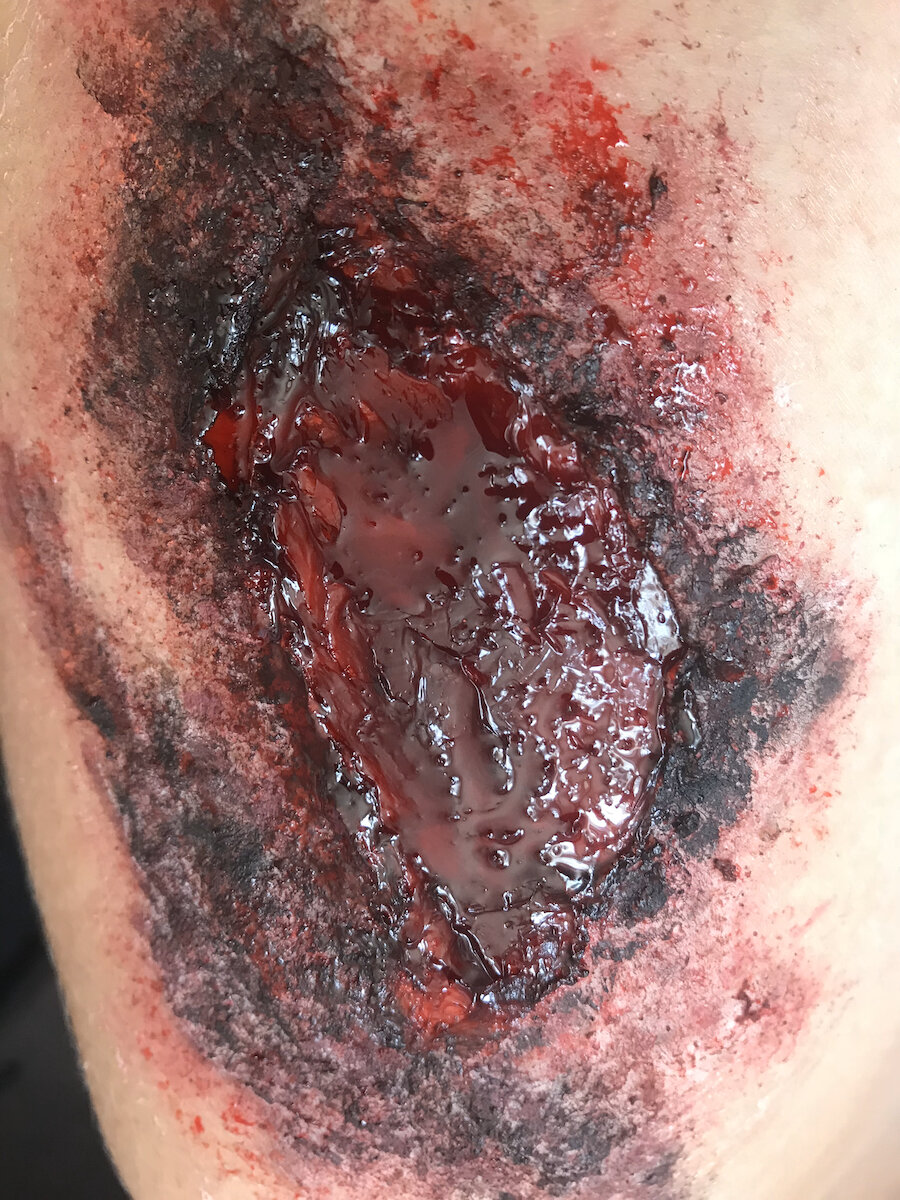 Burn (3rd Degree - On Leg - Severe)