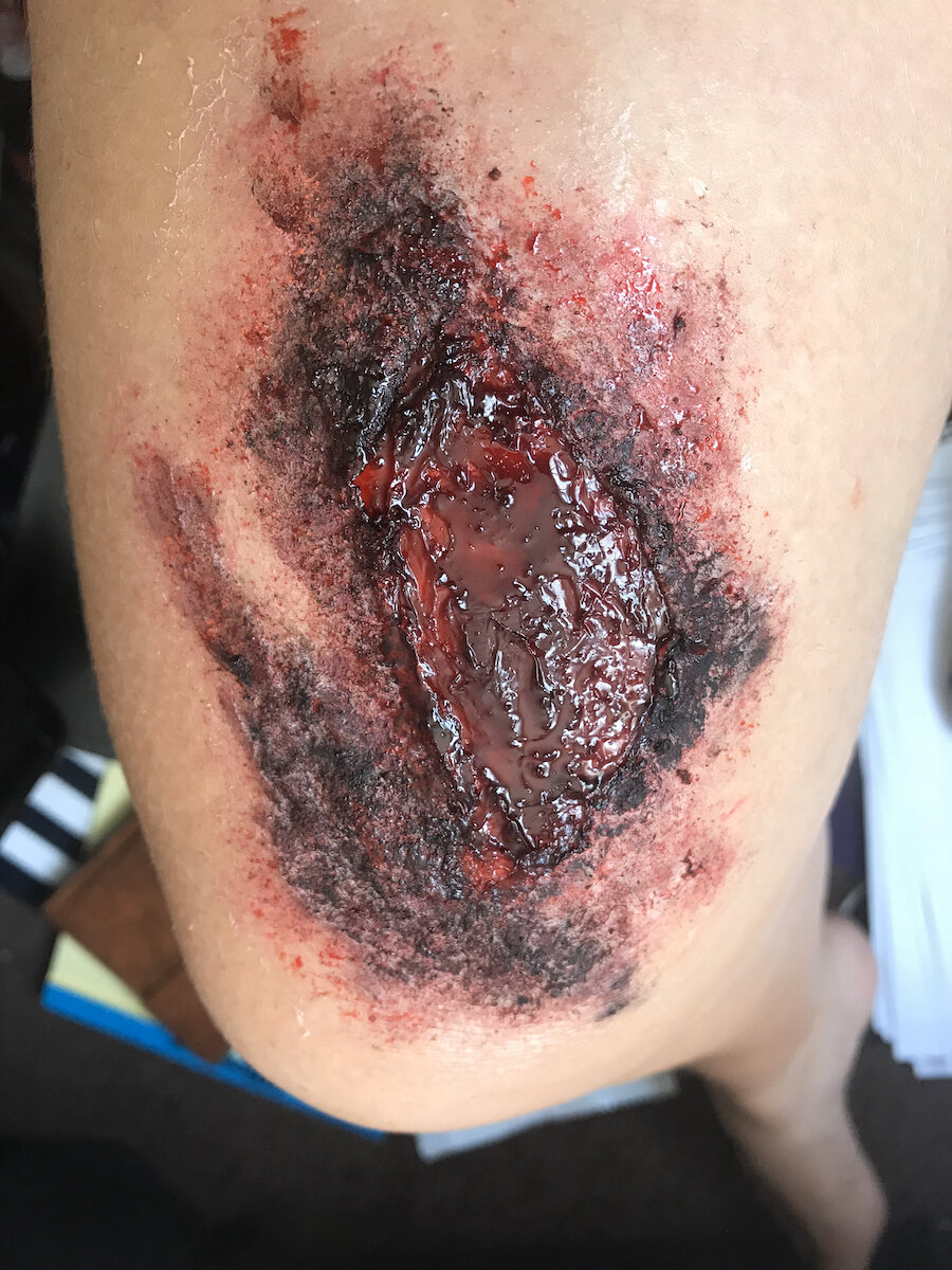 Burn (3rd Degree - On Leg - Severe)