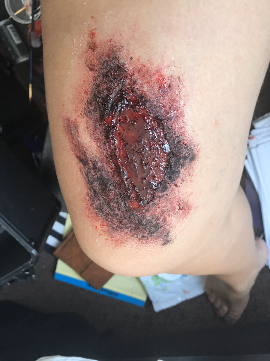 Burn (3rd Degree - On Leg - Severe)