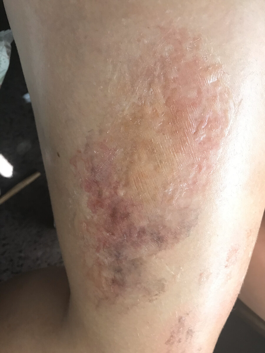 Chemical Burn